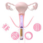 Vaginal Laser Therapy for Gynecologic conditions